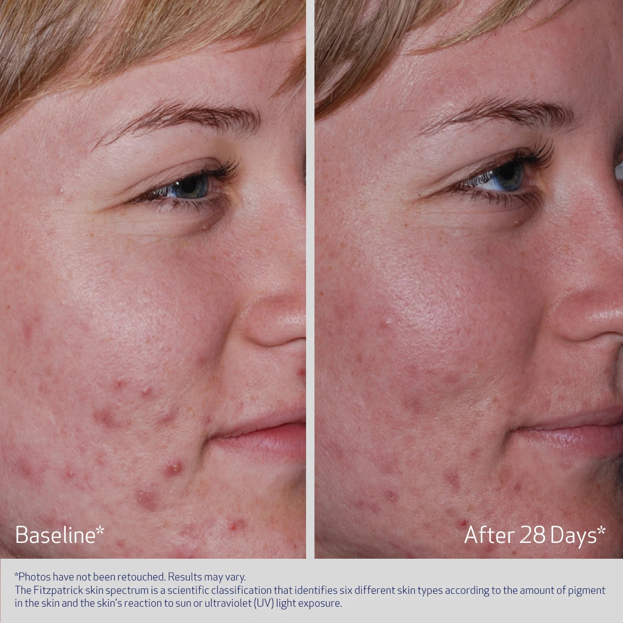 CLENZIDERM ACNE SYSTEM BEFORE AND AFTER AFTER 28 DAYS - PARTICIPANT 1