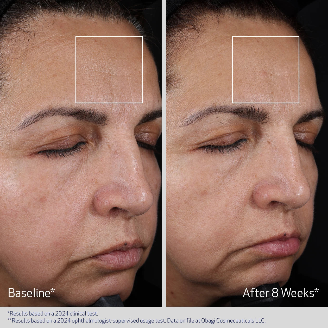 ELASTIDERM ADVANCED FILLER CONCENTRATE BEFORE AND AFTER 8 WEEKS | VISIBLY IMPROVEMENT IN FINE LINES | PARTICIPANT 1
