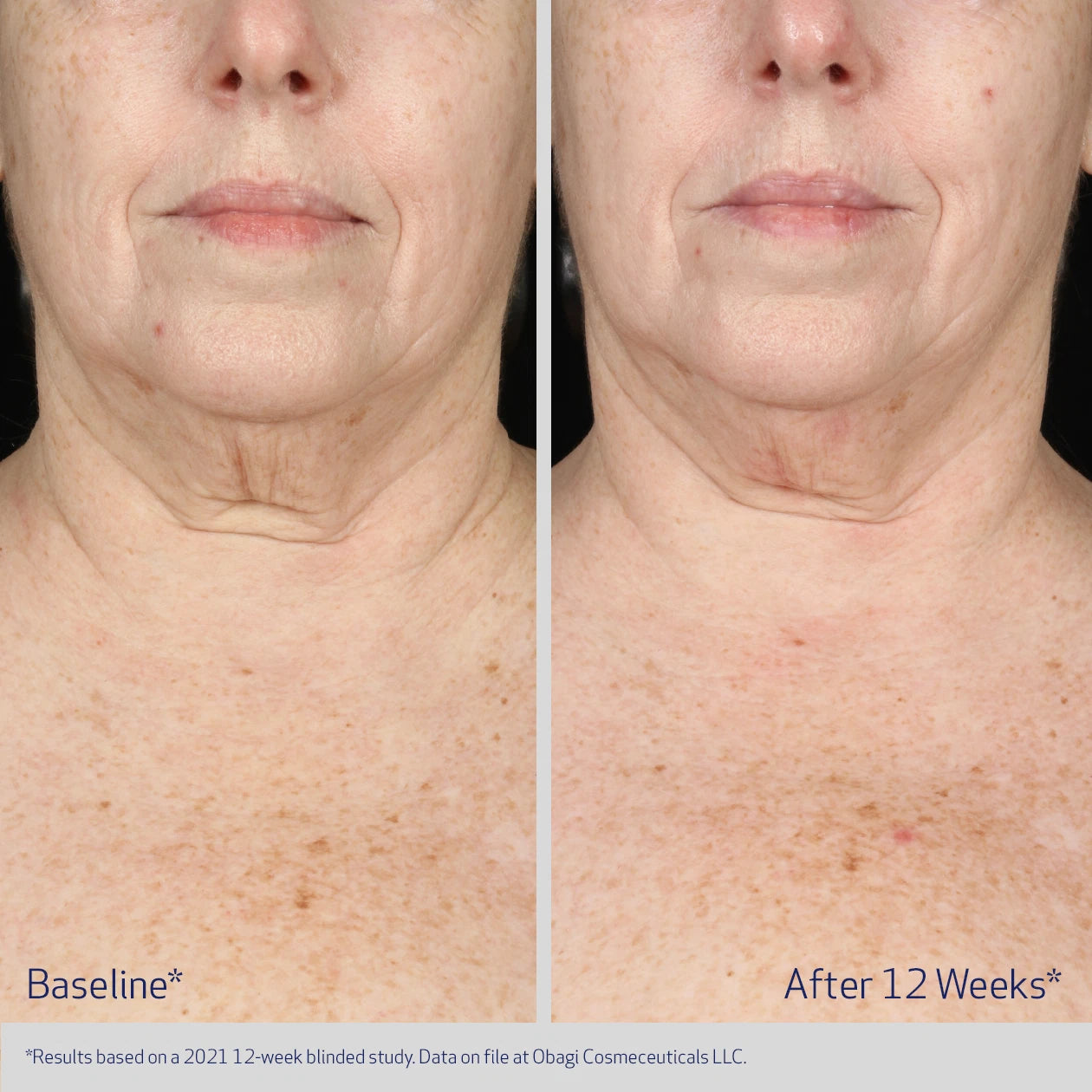 ELASTIDERM NECK AND DECOLLETE CONCENTRATE BEFORE AND AFTER IMPROVEMENT IN SAGGING SKIN AND NECK LINES