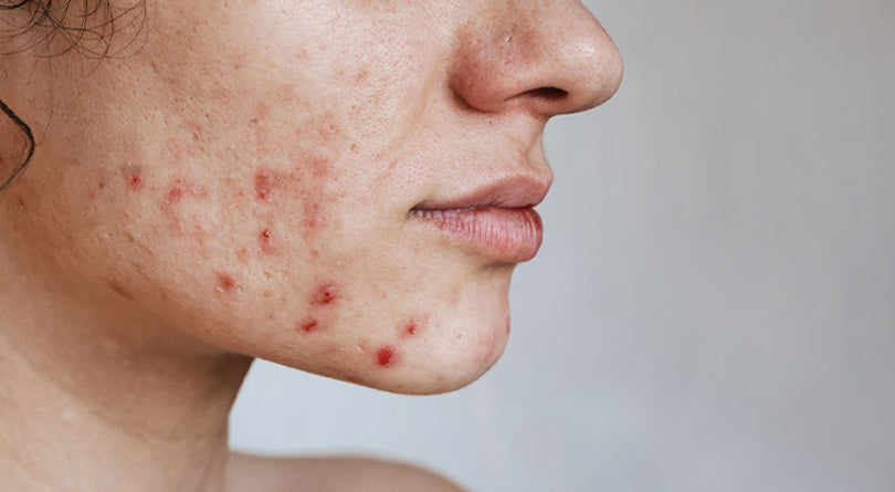 Medical-Grade Acne Treatment:  The Effectiveness of Tretinoin and Hydroquinone