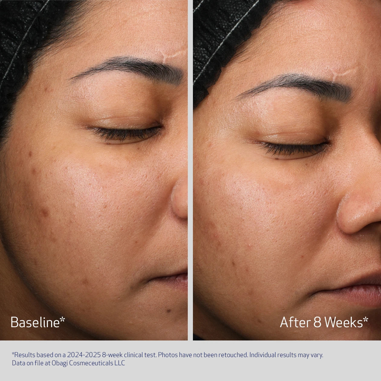 OBAGI RETINOL + PHA REFINING NIGHT CREAM BEFORE & AFTER 8 WEEKS. VISIBLE IMPROVEMENT IN SKIN TONE AND TEXTURE (PARTICIPANT 1)