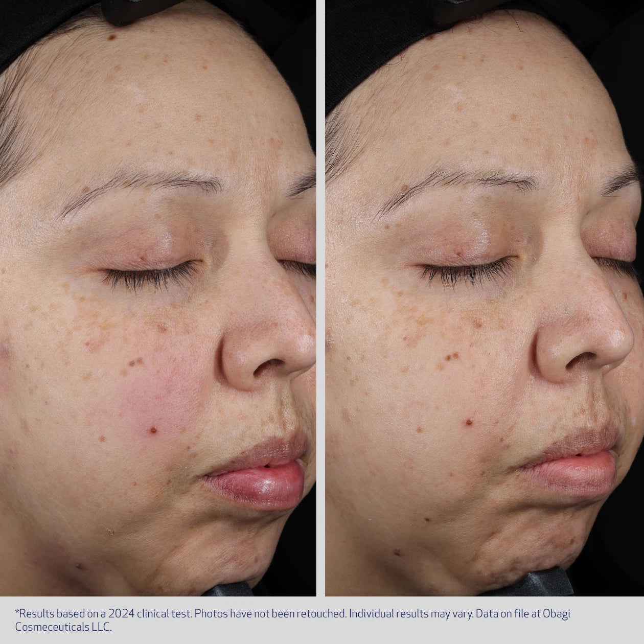 SUZANOBAGIMD MOISTURE RESTORE BEFORE & AFTER REDUCTION IN REDNESS 