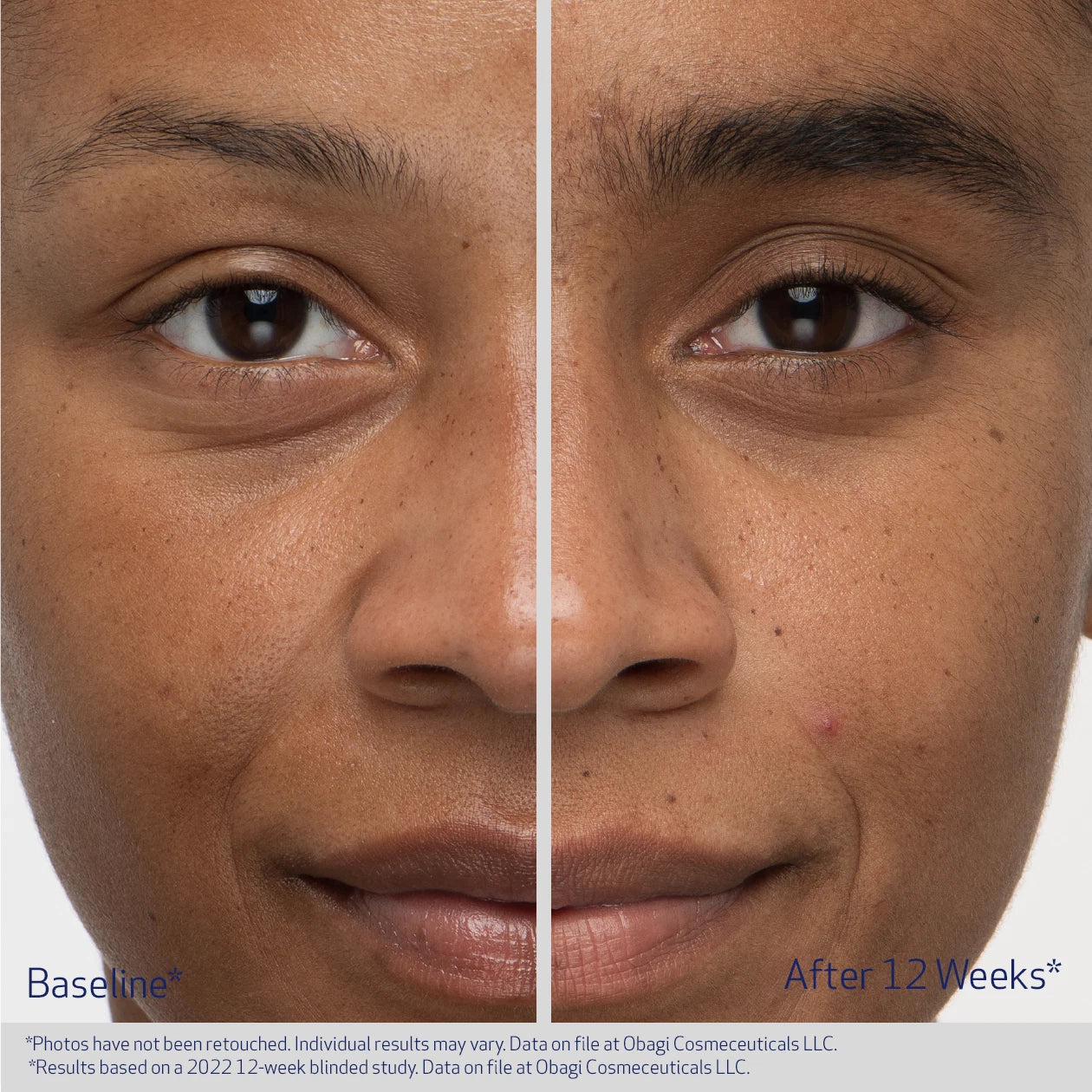 OBAGI NU-CIL BROW BEFORE AND AFTER 12 WEEKS | VISIBLE IMPROVEMENT IN THICKNESS AND DARKNESS OF EYEBROWS| PARTICIPANT 1