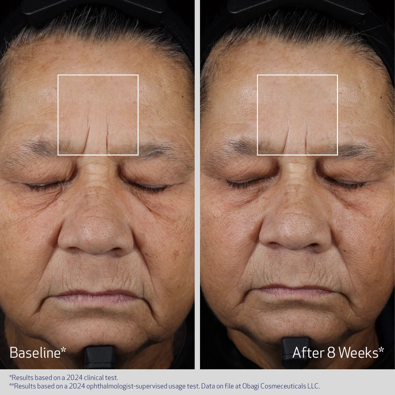 ELASTIDERM ADVANCED FILLER CONCENTRATE BEFORE AND AFTER 8 WEEKS | VISIBLY IMPROVEMENT IN FINE LINES | PARTICIPANT 2