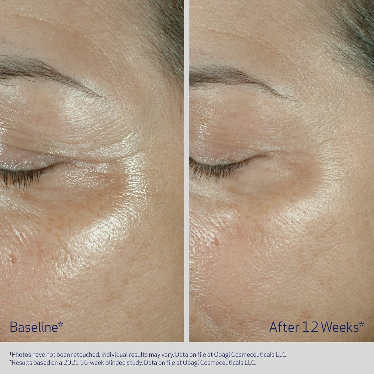 ELASTIDERM EYE CREAM BEFORE& AFTER REDUCTION IN FINE LINES AND WRINKLES