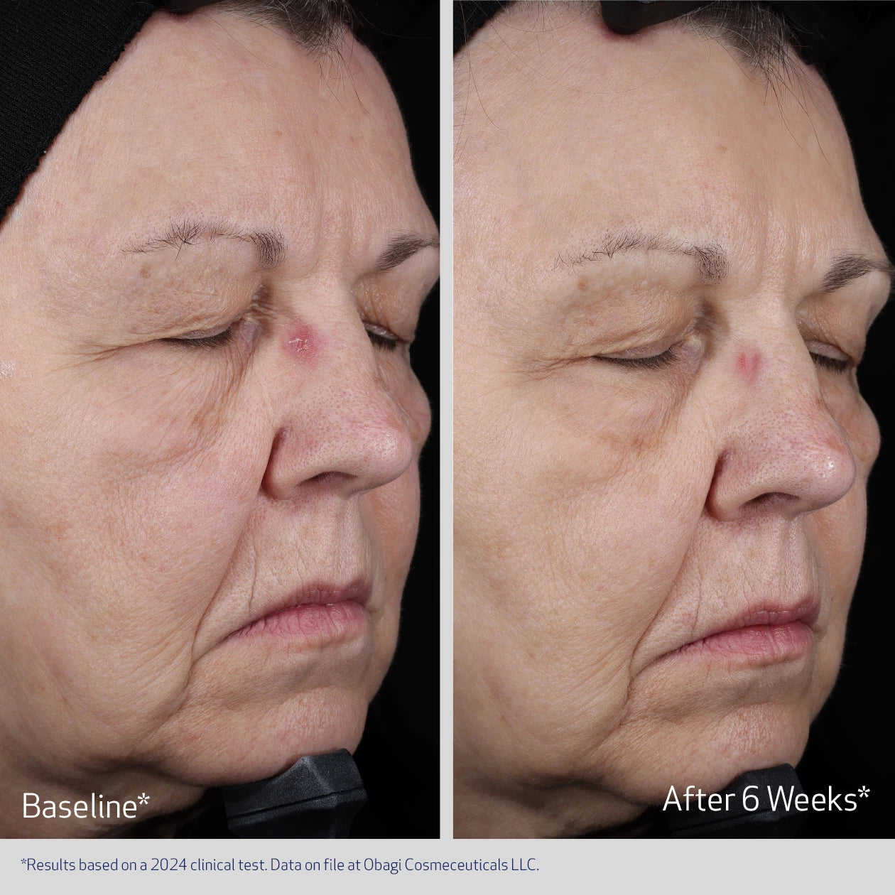 ELASTIDERM LIFT UP & SCULPT FACIAL MOISTURIZER BEFORE AND AFTER 6 WEEKS | VISIBLE IMPROVEMENT IN FINE LINES ALL OVER AND SAGGING SKIN | PARTICIPANT 2