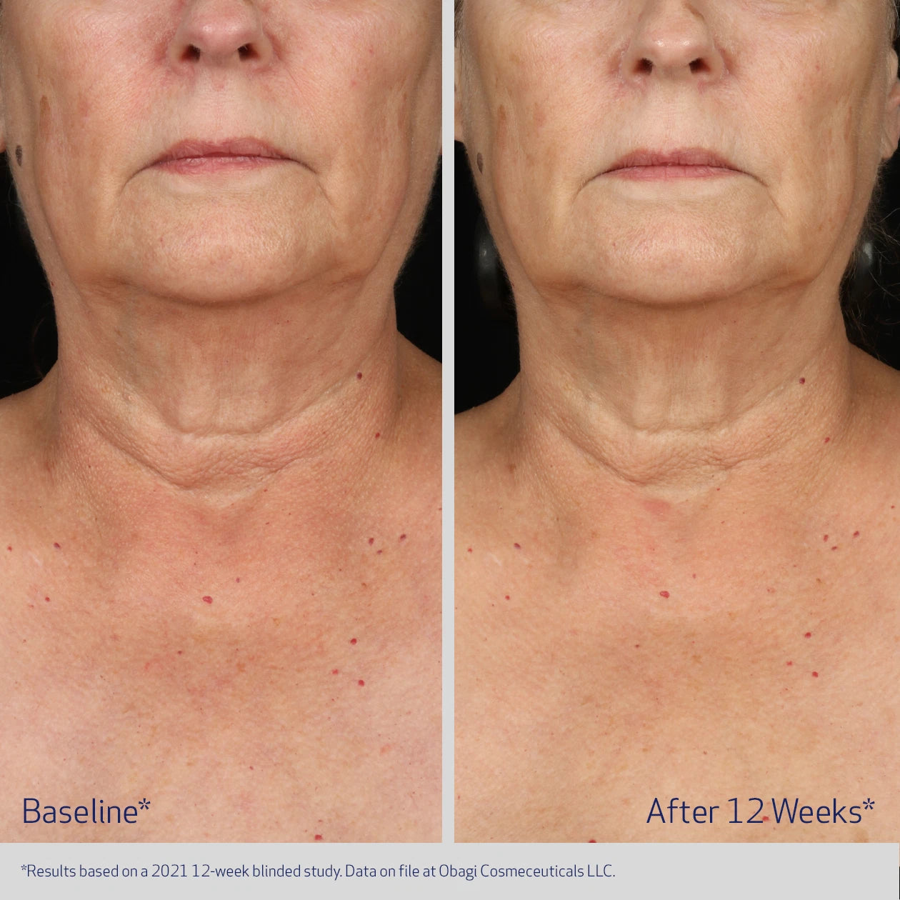 ELASTIDERM NECK AND DECOLLETE CONCENTRATE BEFORE AND AFTER IMPROVEMENT IN SAGGING SKIN AND SKIN DISCOLORATION
