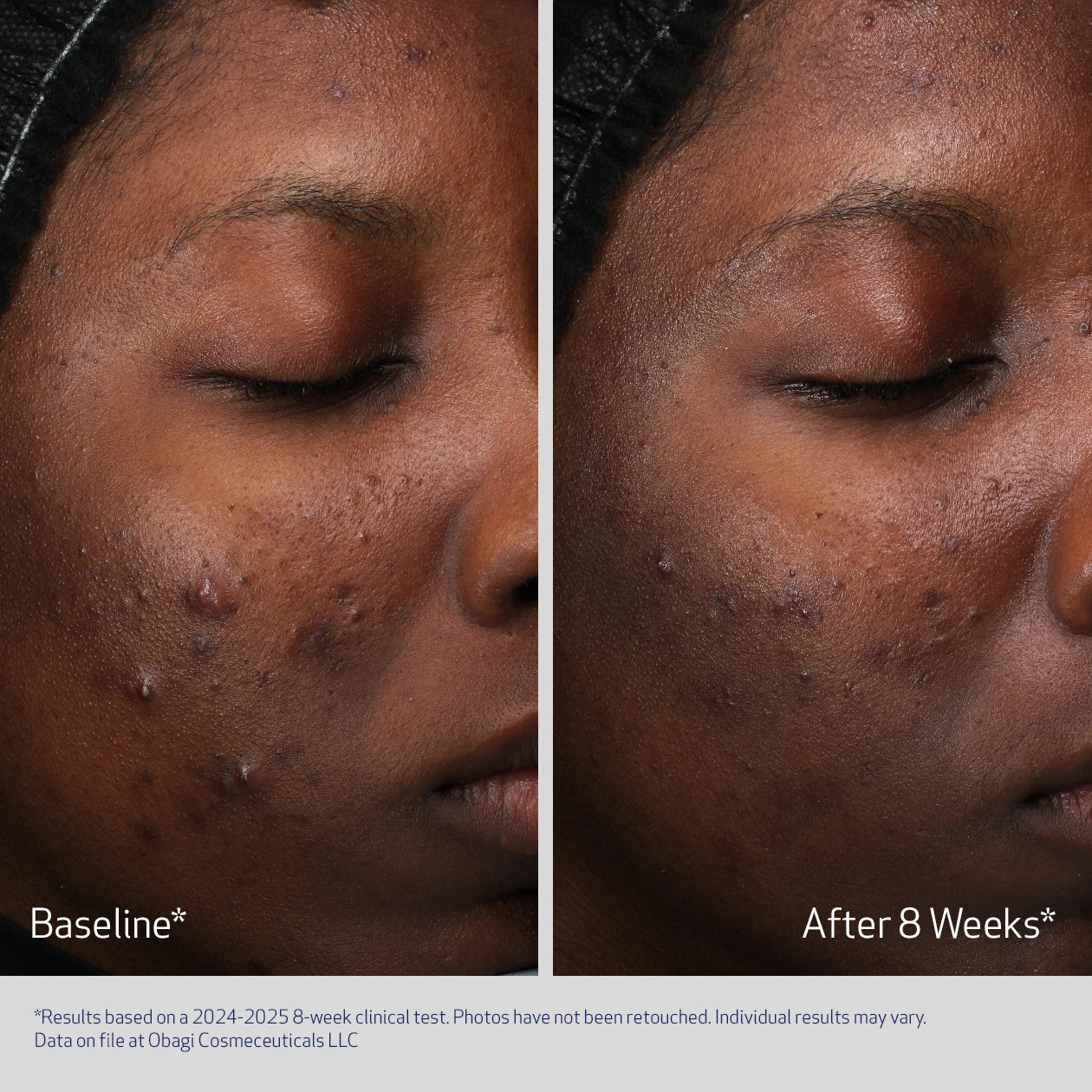 OBAGI RETINOL + PHA REFINING NIGHT CREAM BEFORE & AFTER 8 WEEKS. VISIBLE IMPROVEMENT IN SKIN TONE AND TEXTURE (PARTICIPANT 2)