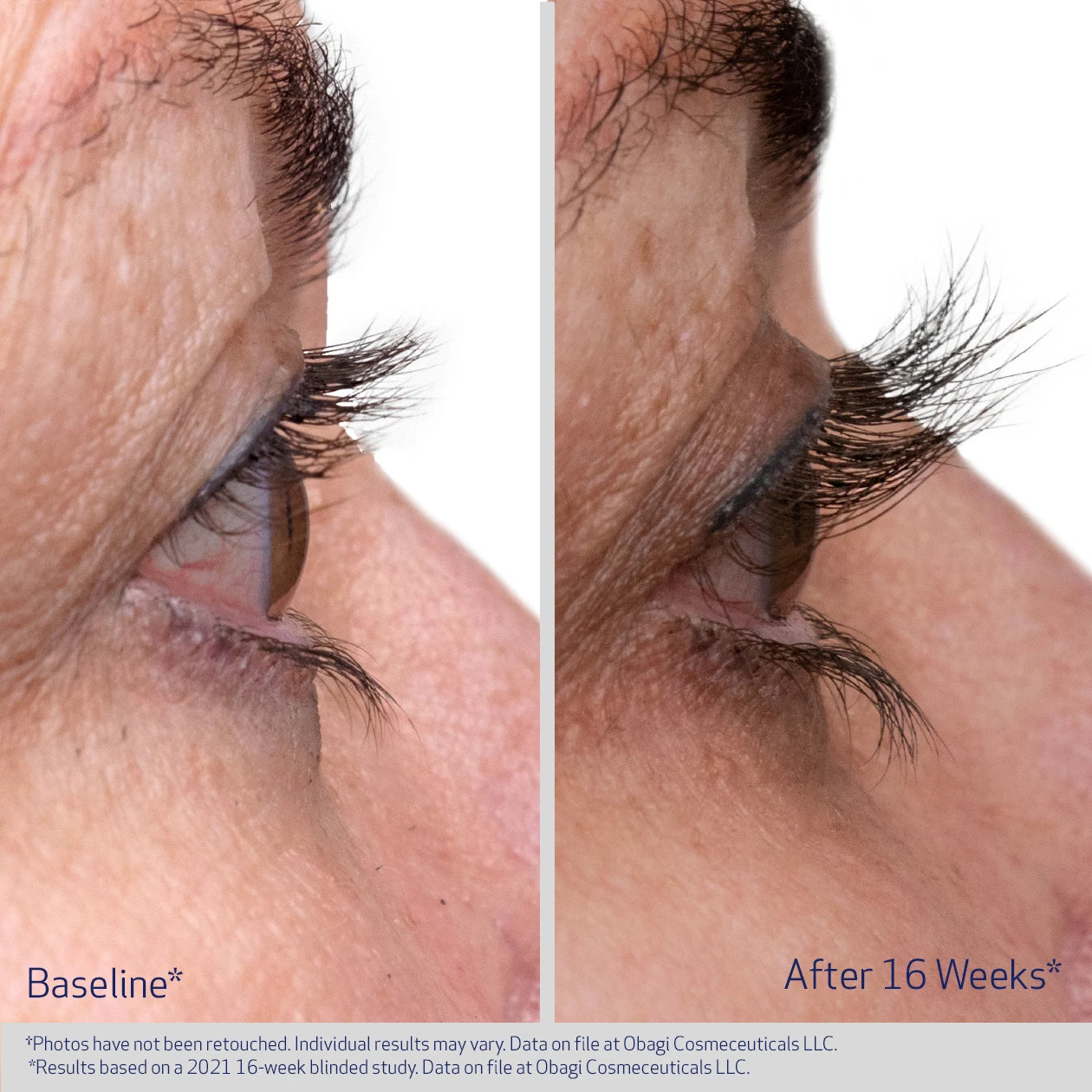 OBAGI NU-CIL LASH BEFORE AND AFTER 16 WEEKS | VISIBLE IMPROVEMENT IN THICKNESS OF EYELASHES | PARTICIPANT 2