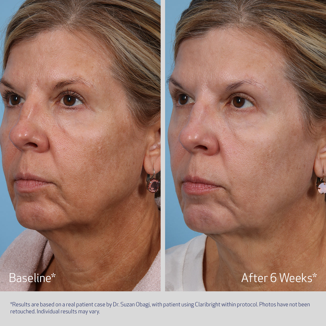 SUZANOBAGIMD CLARIBRIGHT BEFORE & AFTER REDUCTION IN DARK SPOTS AND HYPERPIGMENTATION V1