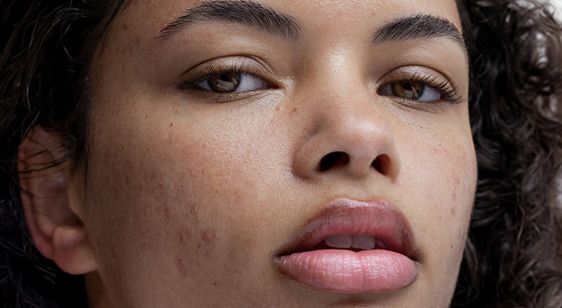 What are the different types of acne?