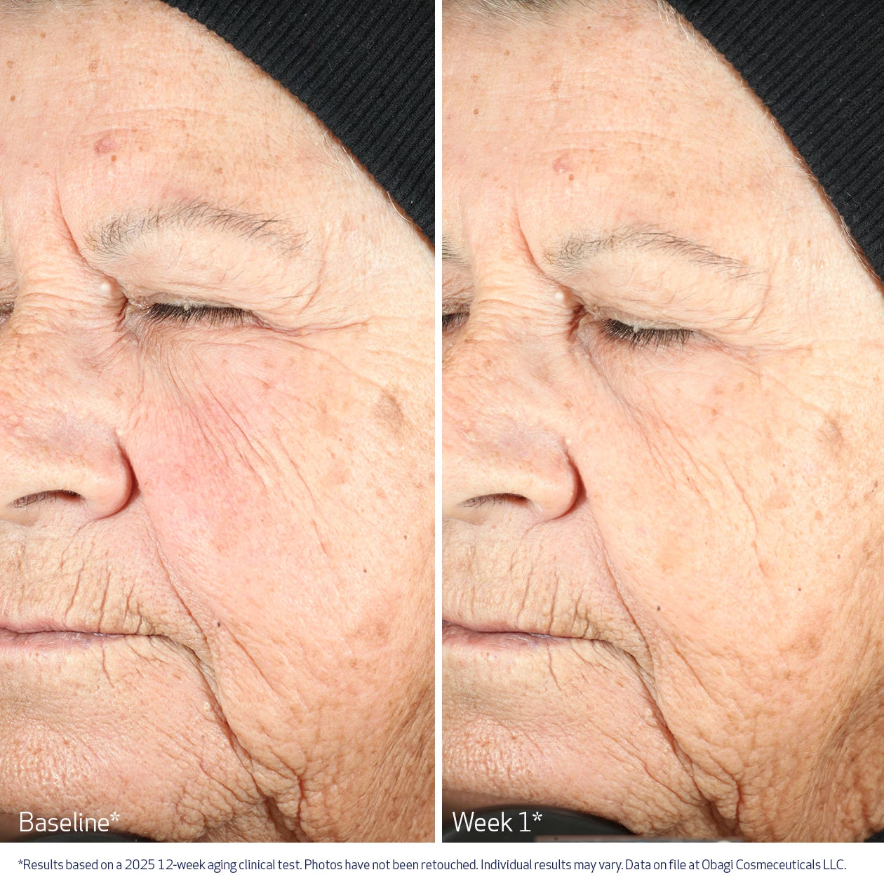 Obagi Nu-Gen Cellular Renewal Serum before & after image - improvement in fine lines and wrinkles after 1 week