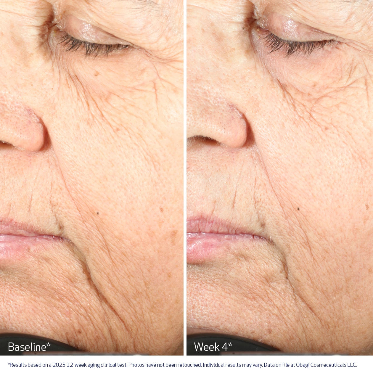 Obagi Nu-Gen Cellular Renewal Serum before & after image - improvement in fine lines and wrinkles after 4 weeks